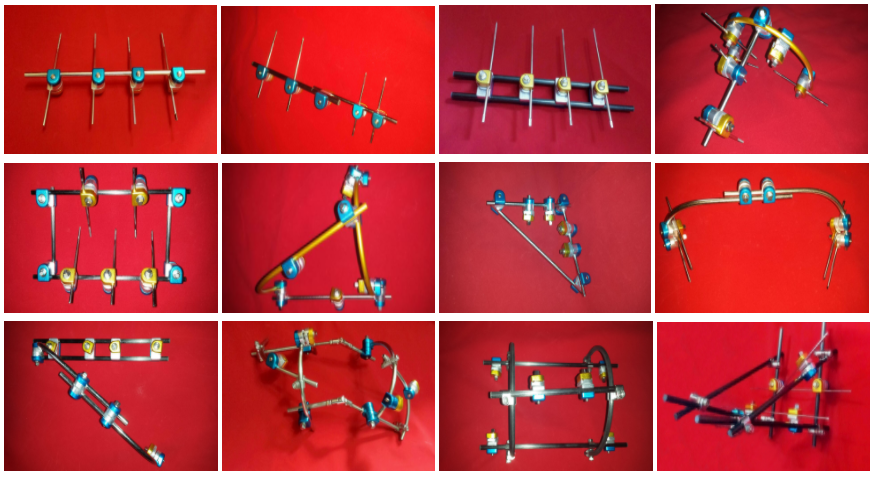 鋼板伴侶——骨折外固定架